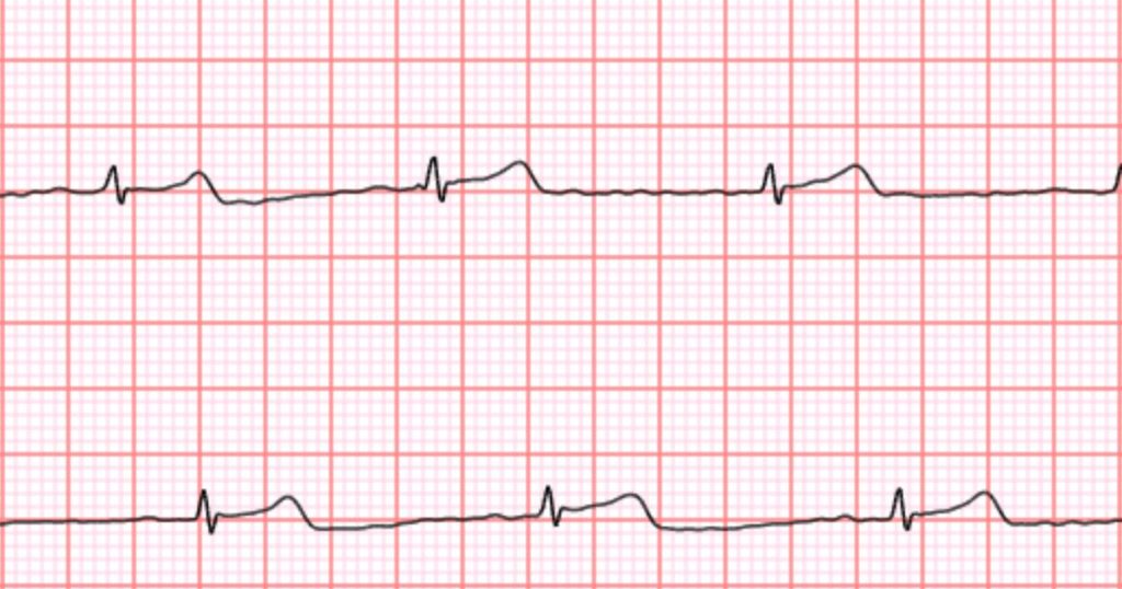 Wellue Blood Pressure Monitor and ECG is an affordable option to monitor your heart health 3